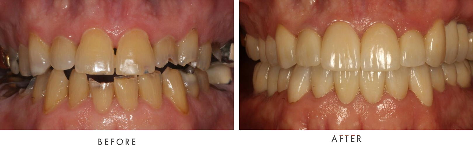 dental crown combined case 2 drscruggs