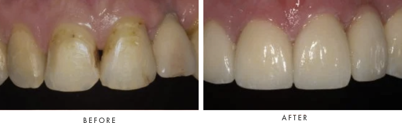 dental crown combined case 3 drscruggs