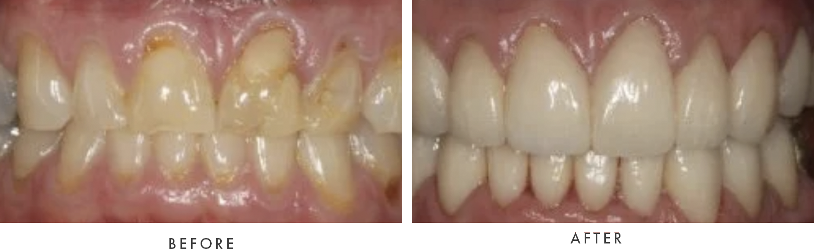 dental crown combined case 5 drscruggs