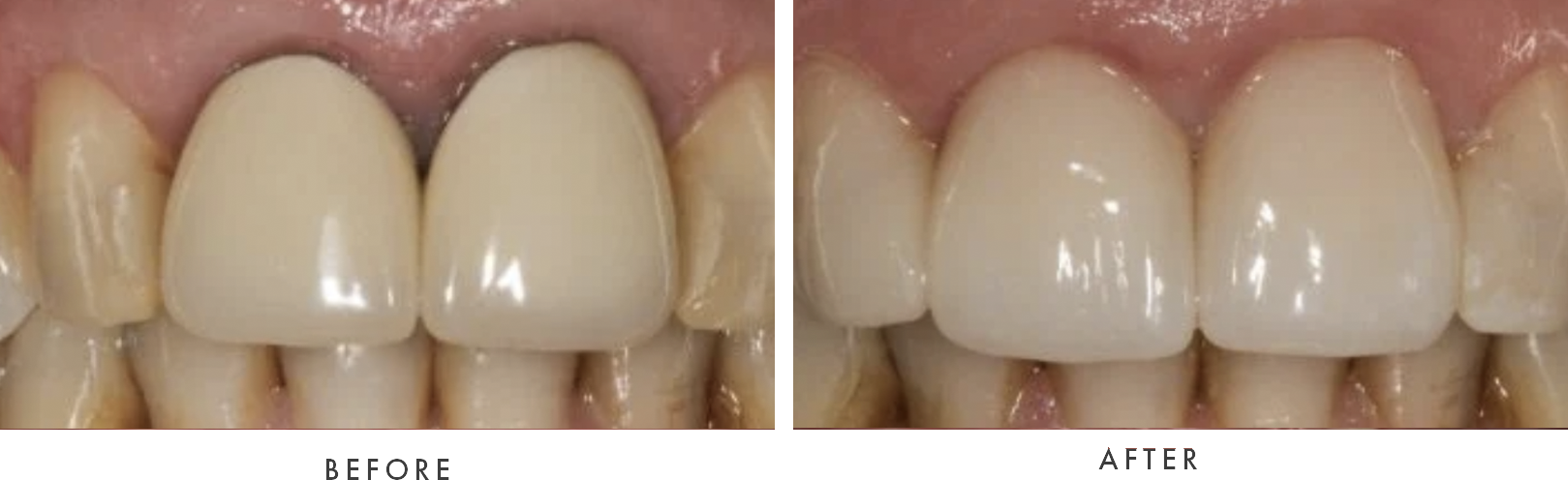 dental crown combined case 6 drscruggs