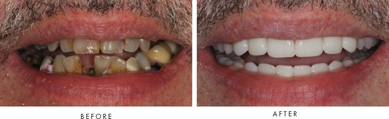removable dentures combined case 1 drscruggs
