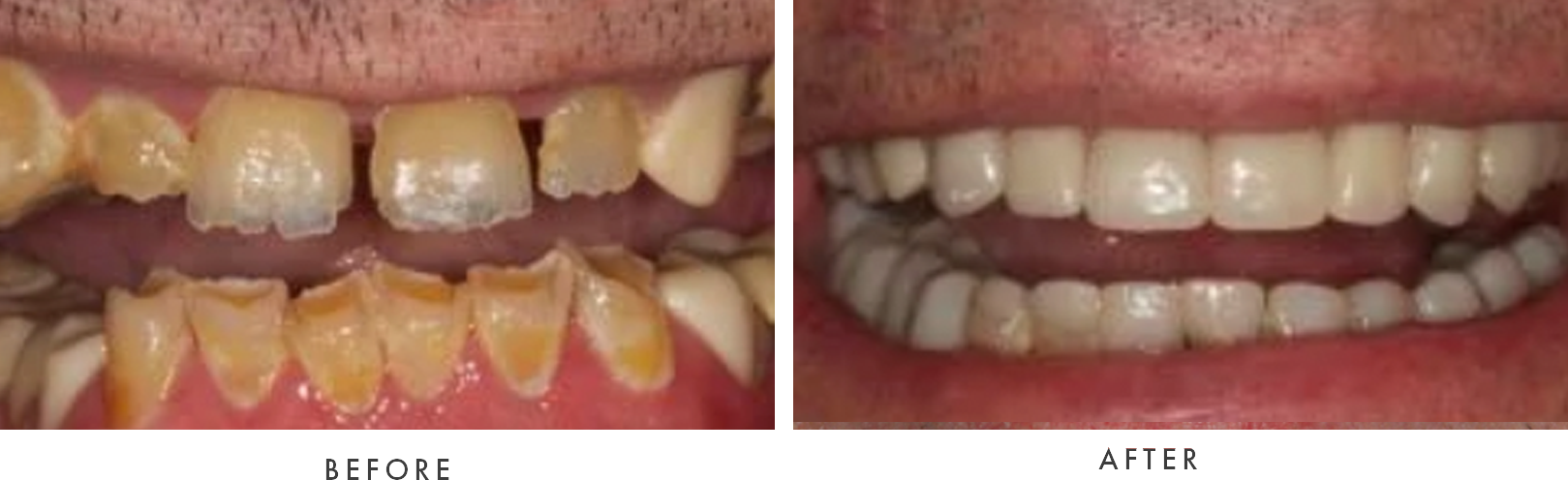 removable dentures combined case 2 drscruggs
