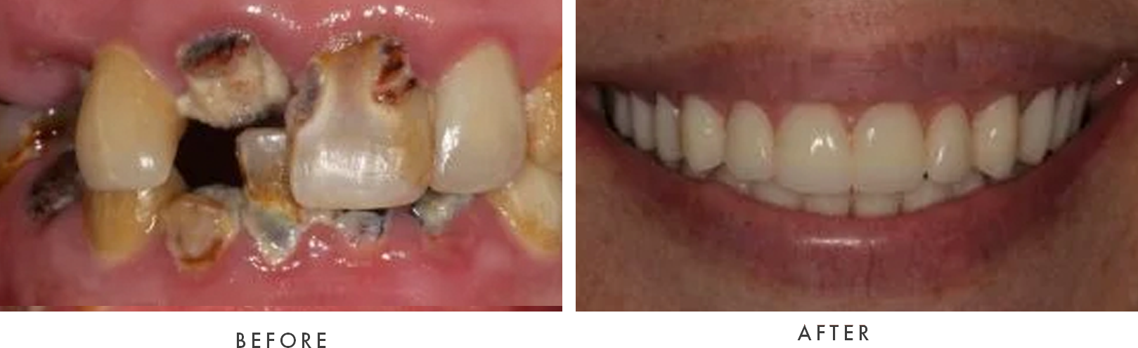 removable dentures combined case 3 drscruggs